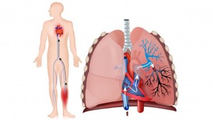 Тромбоэмболия легочной артерии. Симптоматика, причины, лечение