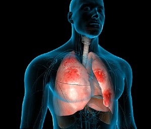 Пневмония – что это такое и как ее лечить