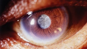 Что такое катаракта и каковы причины ее появления